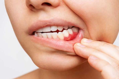 Diş eti çekilmesi diş kaybı ile sonuçlanabilir!